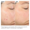 Picture of Salicylic Acid 2% Solution (30 ml)